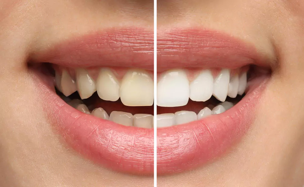 Teeth Whitening
