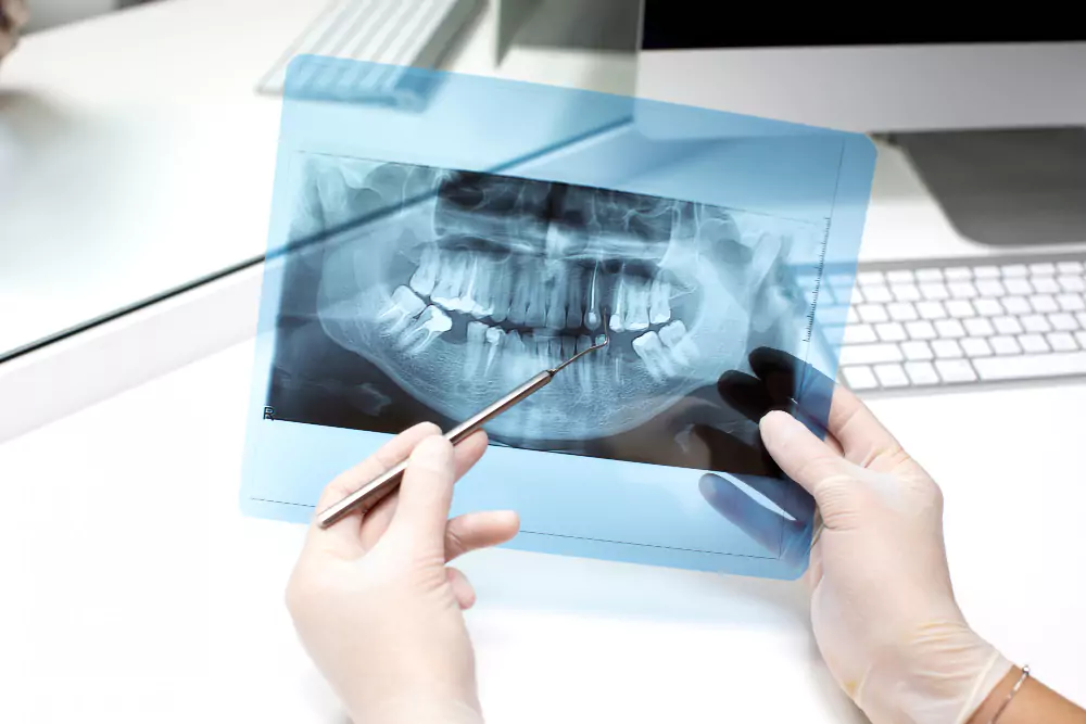 Dental X-Rays