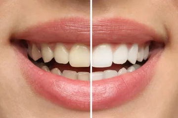 Teeth Whitening